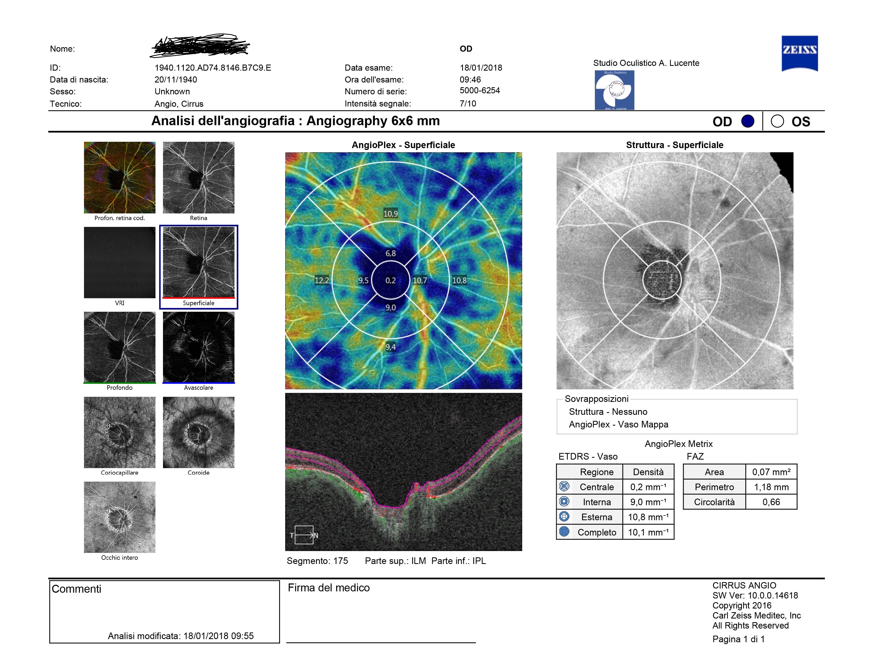 Glaucoma Peripapillare Seconda Parte